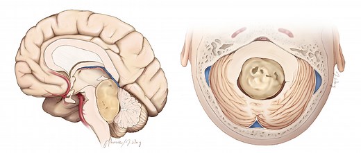 Fourth Ventricular Tumors | Cohen Collection | Volumes | The Neurosurgical Atlas