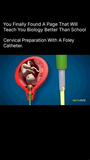 Medical | Health | Anatomy on Instagram: "The image illustrates a medical procedure for cervical ripening using a Foley catheter, specifically identifying a device named INSTARIPE. Purpose: This mechanical method helps dilate and soften the cervix to prepare for labor induction. Mechanism: A catheter with a balloon tip is inserted into the cervix and filled with saline solution to apply gentle pressure. Device Feature: The INSTARIPE device is designed to facilitate rapid ripening and dilation of