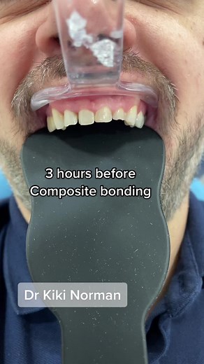 Composite Bonding Procedure Explained in 60 Seconds