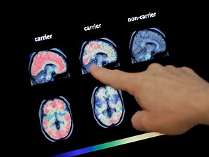 FDA Gives Green Light to Biogen's Alzheimer’s Drug