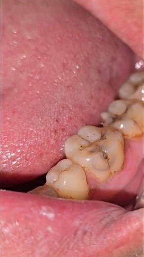 Part1: Buccal pit caries, clinical presentation