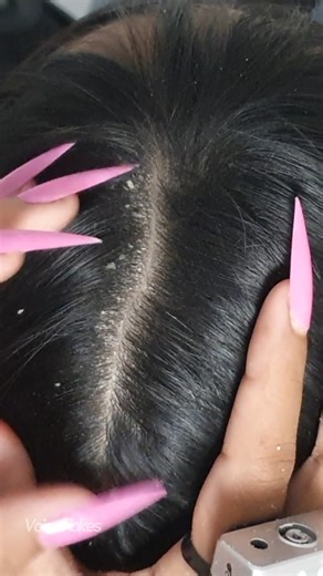 Extreme Flake Pick Off | Deep Scalp Scratch & Instant Relief 😳💆‍♀️ #FlakeRemoval #ScalpScratch #DryScalpCare #DandruffASMR #SatisfyingVideo #ASMRRelax #038 | Voice Flakes