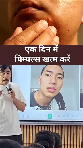 एक दिन में पिम्पल्स खत्म करें 😱😮 #facts #information #education #knowledge #fact #health