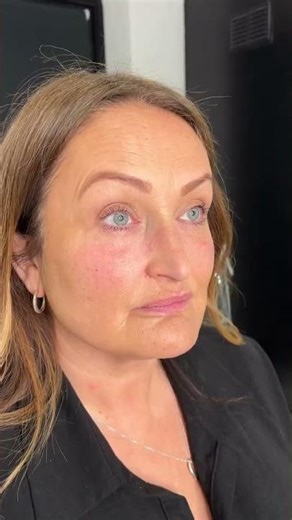 Tear Trough Filler Quick Results #TearTroughFiller #UnderEyeFiller #TearTroughExpert