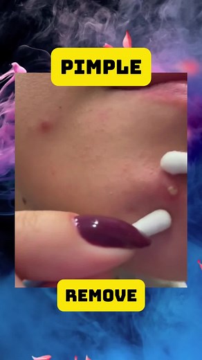 #blackhead #pimple #squeezeyuk #skincare #cysts #satisfyingvideo #removal #sebaceousfilament #abcess #stinks #infection #pue #boil #squeeze #acneskin #fyp #usatiktok #pointblank