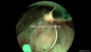 Bladder En-Bloc Endoscopic Dissection