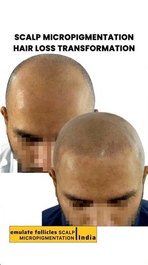Hair Loss Looks and Feels Terrible. Stop Living with It. #menshairloss #mensfashion #india #smp