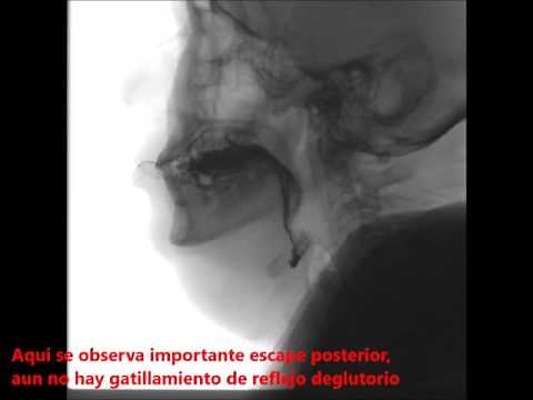 Disfagia videofluoroscopía deglución