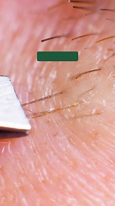 🌟 NHỮNG LƯU Ý CHĂM SÓC DA SAU KHI TRIỆT LÔNG TẠI HASAKI CLINIC 💚 Sau khi triệt lông, chăm sóc đúng cách sẽ giúp da mịn màng và duy trì hiệu quả lâu dài hãy nhớ tuân thủ 4 lưu ý chăm sóc da sau mỗi buổi triệt nhé! 🚫 Không wax hoặc nhổ lông trong quá trình triệt. Nếu cần dọn lông, bạn có thể cạo, nhưng nhớ cạo theo chiều mọc của nang lông, tránh cạo ngược có thể tổn thương da, gây tình trạng lông mọc ngược, viêm nang lông. 💦 Tránh tiếp xúc với nước trong 2 tiếng đầu tiên sau khi triệt để bảo v