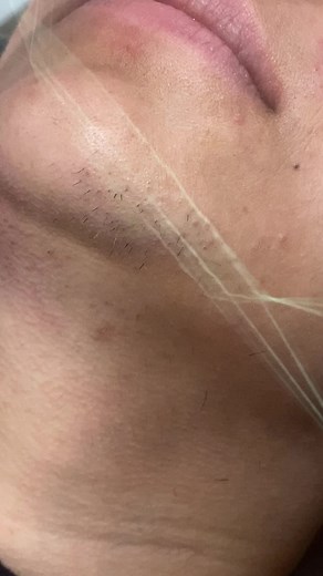 Chin threading in action #threading #viral #fypシ #browstutorial #brows #threadingtime #chinthreading #foryou #foryoupage