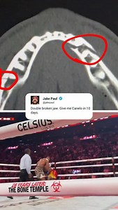 Jake Paul shared an X-Ray of his jaw after his loss to Anthony Joshua 😳 (via @jakepaul) | SportsCenter