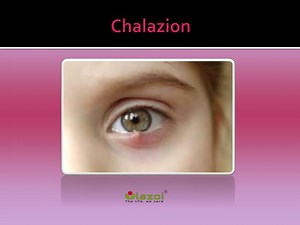Chalazion - SlideServe
