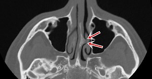 Ossified Overhang (Osteophyte) In The Nose That May Cause Atypical Headaches