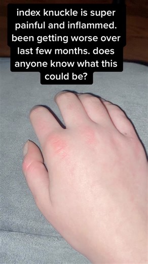 Knuckle Pain Relief: Causes, Symptoms, and Treatment Options