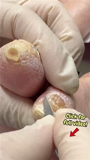 Part 1: Removing Rock-Hard Corns on the Tip of the Toe #shortsfeed #satisfyingshorts #shortsvideos