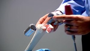 Extraction of SIGMA® HP Revision Femoral Trial Components