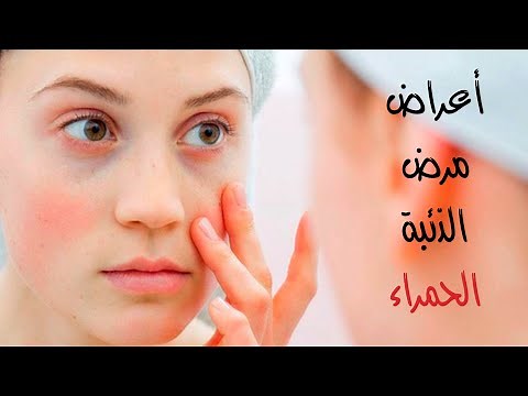 الذئبة الحمراء | أسبابها، أعراضها وكيفية علاجها