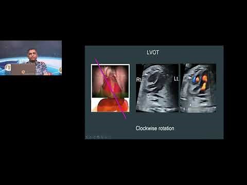 GE Webinar: Fetal Echocardiography: Practical Guideline - Dr BS Rama Murthy