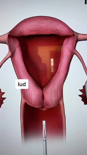 Baby Care: Understanding IUD Insertion and Birth Control Methods