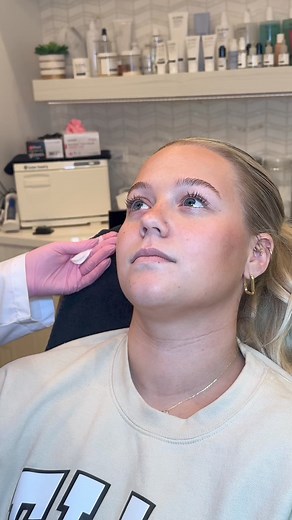 1.3K views | LIP FLIP IN REAL TIME : The Lip is injected with botox to relax the muscle , causing the lip to flip upward and make the lips look fuller! Results appear within 2 weeks! This procedure is between $42-78 , making it super affordable. Ideal for someone with a gummy smile, before an event or just wanting the look of a natural fuller upper lip. See Terrah here at elle, or message us with any questions! @getskindeephealth | Elle Salon | Facebook