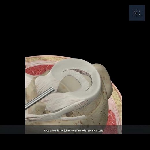 Bucket Handle Meniscus Tear Repair
