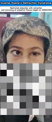 Inverse Duane's Retraction Syndrome