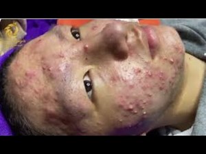 6 Min of pure Satisfaction - Pimple Popping Extravaganza