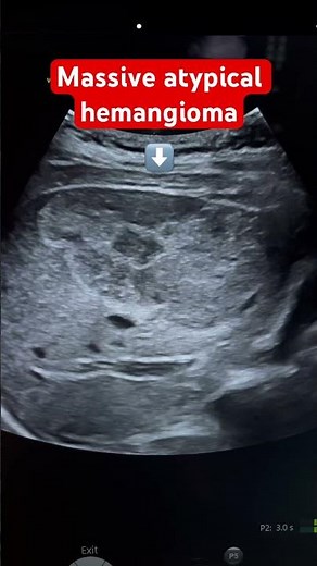 Large atypical liver hemangioma Ultrasound | MRI proved | large benign hepatic mass | ARDMS