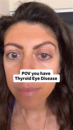 Elena | Graves Disease & Thyroid Eye Disease Advocate, Coach on Instagram: "I told myself I wouldn’t be in the 50% of Graves patients that gets Thyroid Eye Disease… but I was wrong 😑 Diagnosed with graves at the end of Dec 2022, I noticed my eyes were super watery in April, and then more noticeable symptoms like eye bulging, redness, and swollen caruncle (inner corner of eye) made it obvious that I had to go see an ophthalmologist. By June I had an official diagnosis after getting an MRI. But l