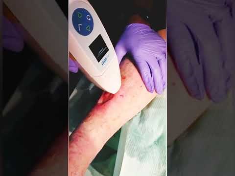 Ultrasonic mist debridement for wound care treatment and healing