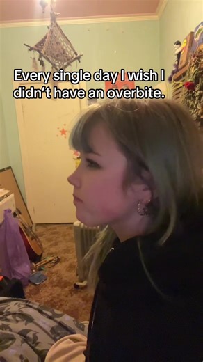 Overbite Challenges: Living with a Misaligned Smile