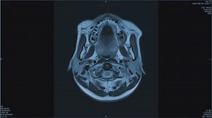 Magnetic resonance images of the brain, MRI of the brain, of a patient with multiple vascular infarctions, top view contrast, monochrome animation Seamless Loop.