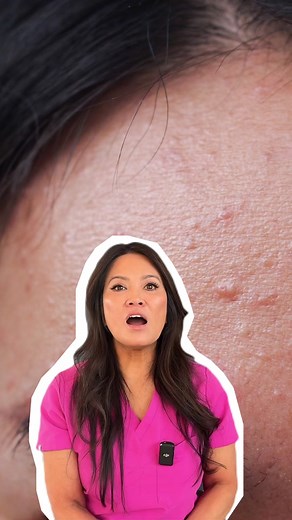 If you ONLY get pimples on your forehead and temples, here's how to fix it (according to your favorite board-certified dermatologist) 💛 #acne #pomadeacne #foreheadacne #oilyskin #oilyskincare #acneskincareroutine #acneskincareproducts #drpimplepopper #acnetips #foreheadpimple #pimples #dermatologist #dermtips #dermatologisttips