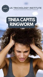 Tinea Capitis - The Fungal Infection That Can Cause Permanent Hair...