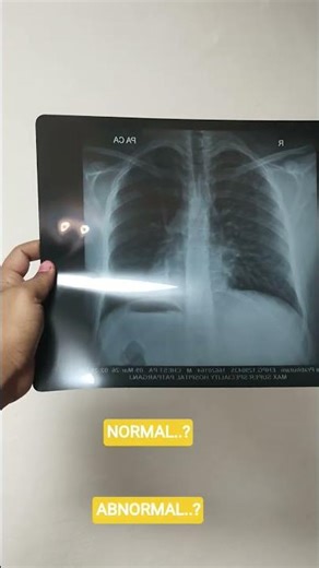 chest x ray normal vs abnormal #xray #chest #pulmonology #neet #nursingofficer #who #hospital #icu