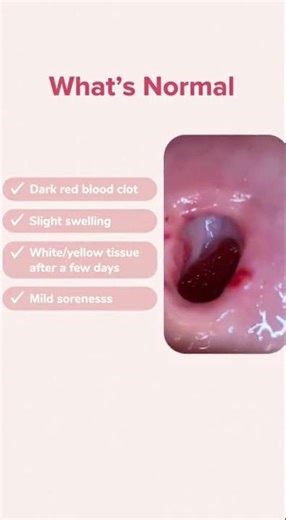 almost everyone checks their wisdom tooth extraction site and thinks, “Is that normal?”