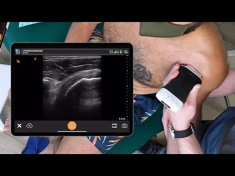 Ultrasound of the Rotator Cuff