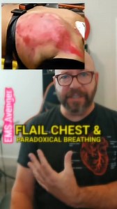 This is one of my favorite flail chest videos as it is anterior view as opposed the posterior view we see in one of the most circulated flail chest videos (Pinned). It also promotes good discussion around management as this is a not an ideal position and restraint approach to this patient. #EMS #EMTs #Paramedics #firstresponders | EMS Avenger