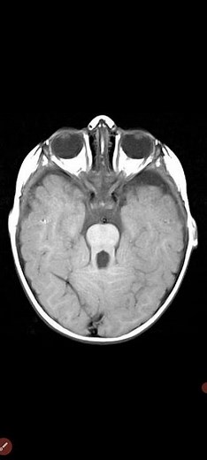 Joubert syndrome. Sign,symptome and Diagnosis of Joubert syndrome