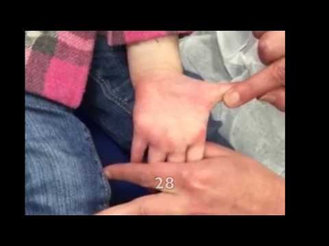 Burns 301: Pediatric Palm Stretch