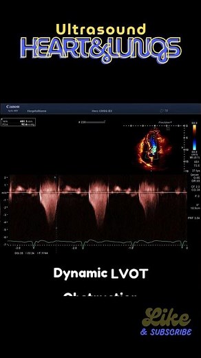 HOCMP with SAM & obstruction #echocardiography #ultrasound #HOCMP