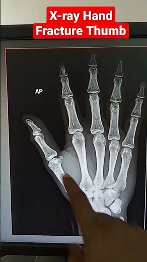 FractureThumb | X-ray Hand #shorts #xray #fracture #radiography