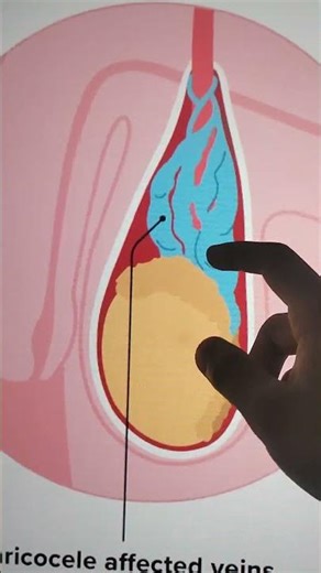 Varicocele condition in testise pain and inflammation#varicocele grade #testise