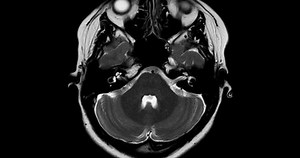 MRI Brain Axial T2 can help doctors look for conditions such as bleeding, swelling, tumors, infections, inflammation, damage from an injury or a stroke diseases.
