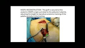 Medial Quadriceps Tendon- Femoral Ligament Reconstruction