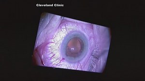 Blind man has vision restored after surgery to implant a bionic eye