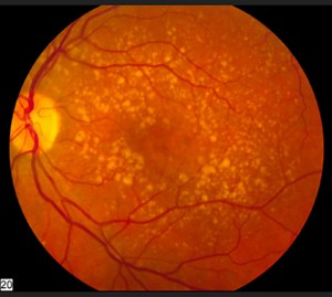 AI trained to spot heart disease risks using retina scan