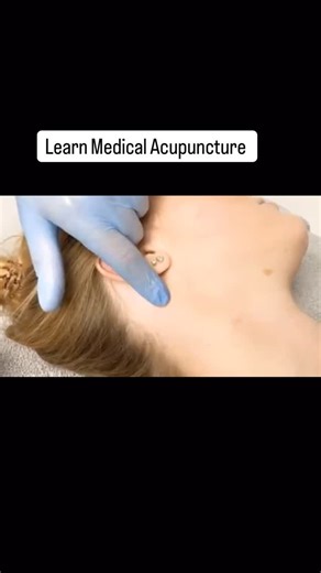 Dry Needling | OMT Training A brief look at safe, clinically applied dry needling for the cervical region, as taught on OMT Training programmes. Learn these techniques either: • Face-to-face in London (2026 courses) • Online via the OMT Online platform – study anywhere, anytime All courses are fully accredited, CPD accepted, and certificated, and are open to manual therapists across the full professional spectrum including physiotherapists, osteopaths, chiropractors, sports therapists and massag