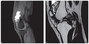 Recovery From Basal Thumb Joint Surgery Dr Huang Md Dmg