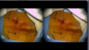 MIS Approach to TLIF